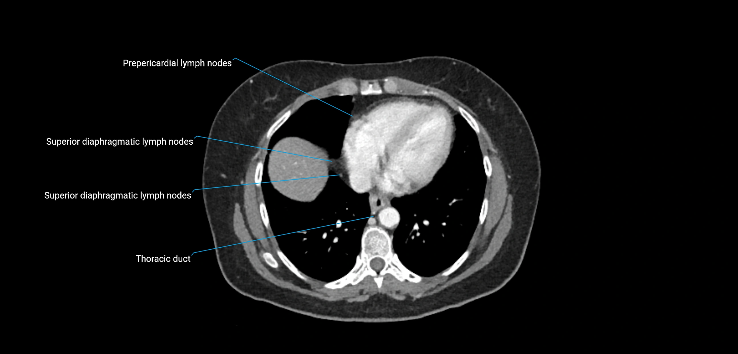 CT ct abdominal lymph nodes  axial cross sectional anatomy  enchanced radiology image -img-00002-00054.webp